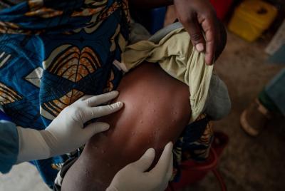 The mpox virus is spreading through parts of Africa. (Photo: World Health Organization via X.)